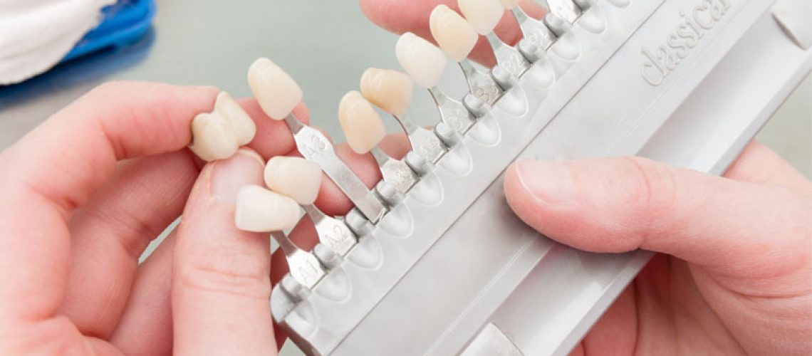 Dentist Holding A Row Of Dental Veneer Models