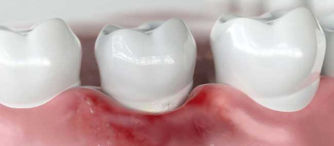 a model portraying receding gums